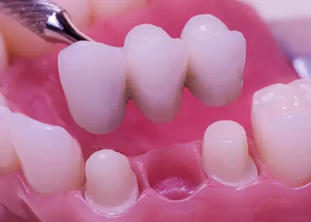 teeth Replacement