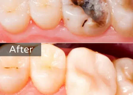 Fillings