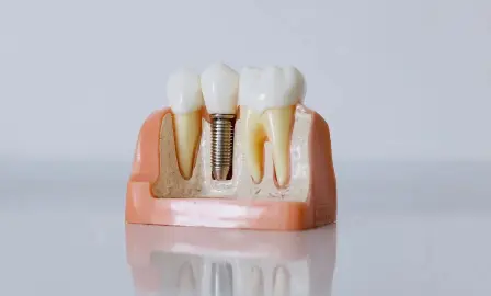 Implant Therapy